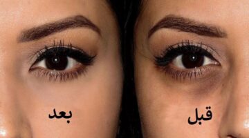طرق إزالة الهالات السوداء تحت العين طبيعية جدا وسهلة وهتدي نتيجة سريعة «عينيكي هترتاح»