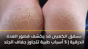 تشقق الكعبين قد يكشف قصور الغدة الدرقية | 5 أسباب طبية تتجاوز جفاف الجلد