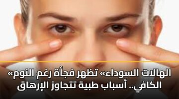«الهالات السوداء» تظهر فجأة رغم النوم الكافي.. أسباب طبية تتجاوز الإرهاق
